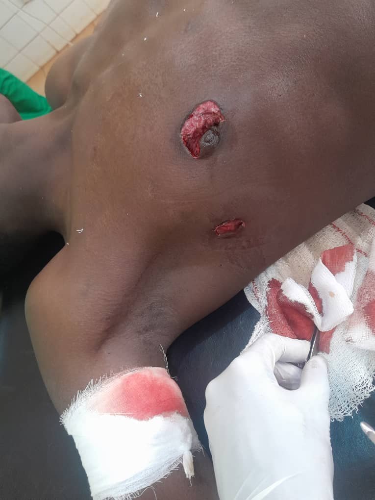 Siguiri/Fouékolen : Un jeune homme blessé par balle lors d’une manif contre la Sag.