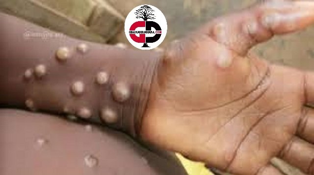 Urgent/ Guinée : le premier cas de la variole du singe MPOX, confirmé ( source médicale)