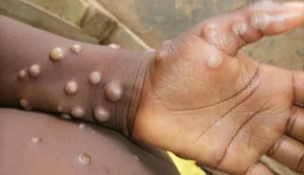 Urgent/Guinée : Neuf (9) cas suspects de la variole du singe MPOX recensés par l’ANSS. 